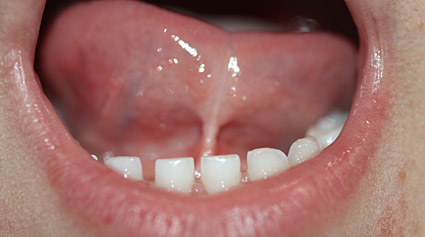 frenillo lingual corto