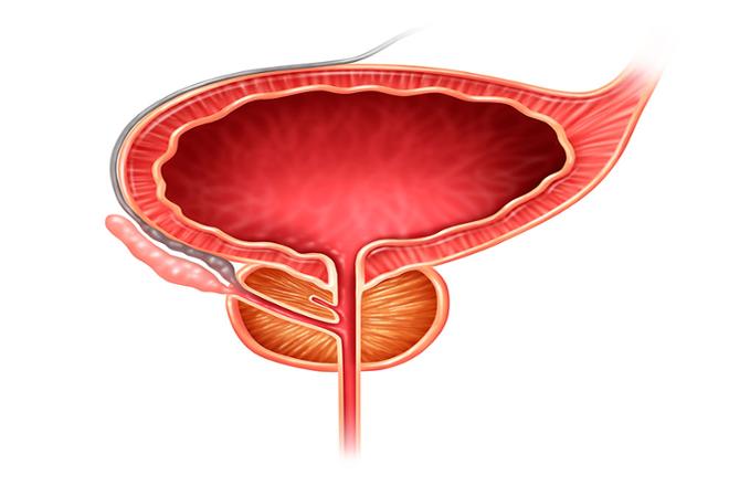 cáncer de próstata