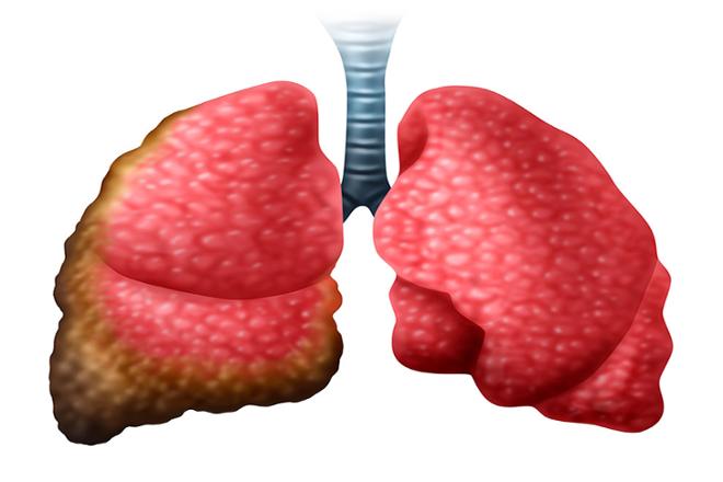 cáncer de pulmón