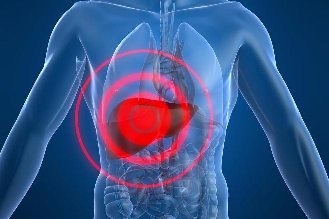 Litiasis renal
