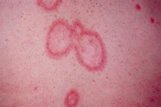 Preguntas frecuentes sobre lupus eritematoso