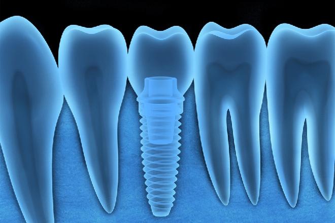 dudas implantes dentales, preguntas frecuentes implantes dentales