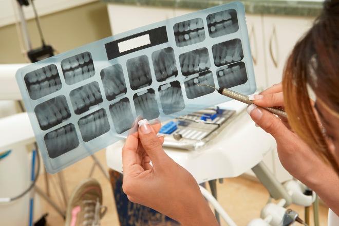 amalgamas dentales en odontologia