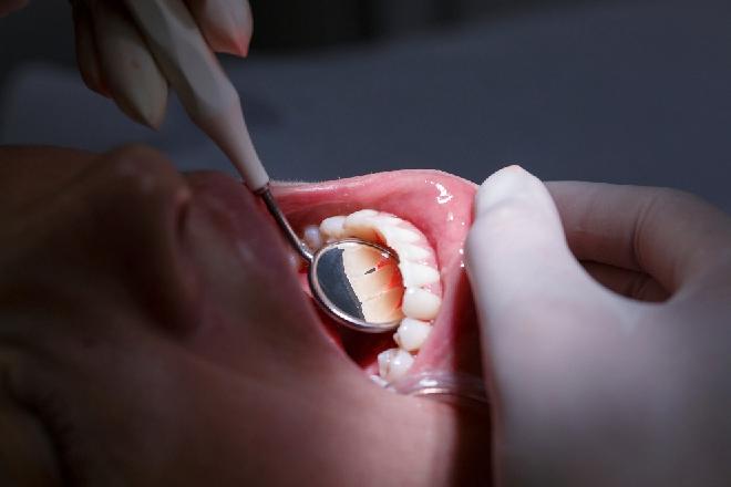 bolsa periodontal