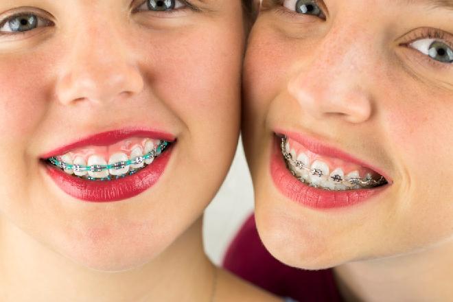 brackets colores, brackets de colores