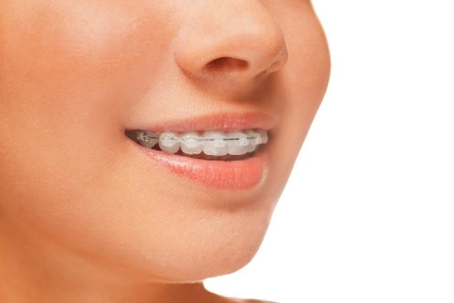 brackets porcelana, brackets de porcelana