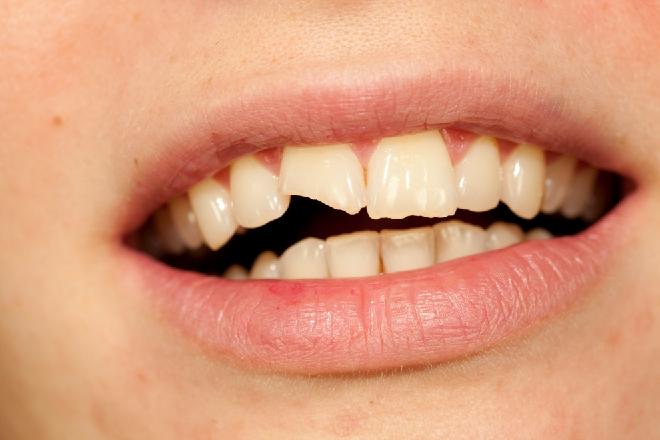 reconstrucción dental