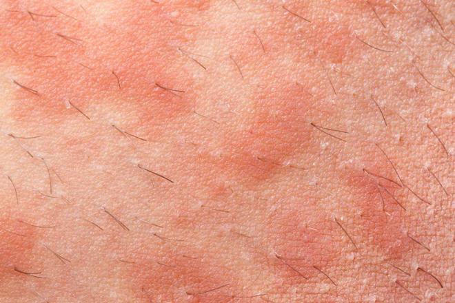 Eczema inflamación de la piel
