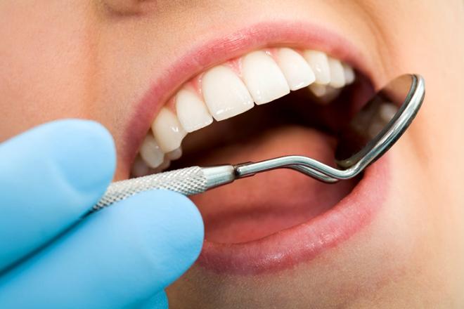 caries radicular, caries en la raíz
