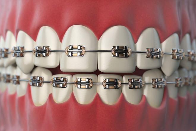 ¿Cómo se usa la cera para brackets?