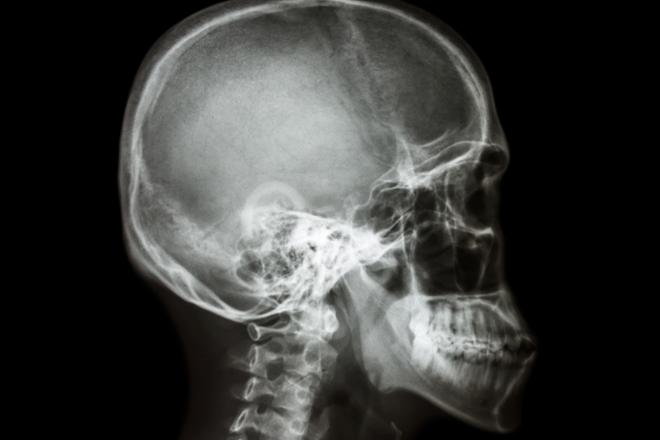 telerradiografía, telerradiografía lateral