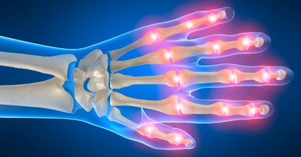 artritis articulaciones