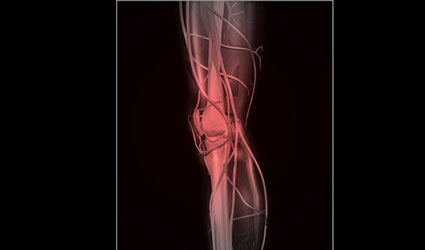 tendinitis patelar