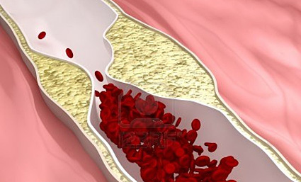 arterioesclerosis de las extremidades
