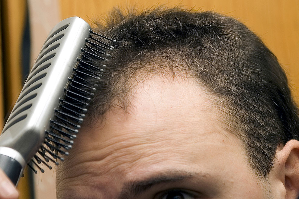 técnicas de implante de pelo