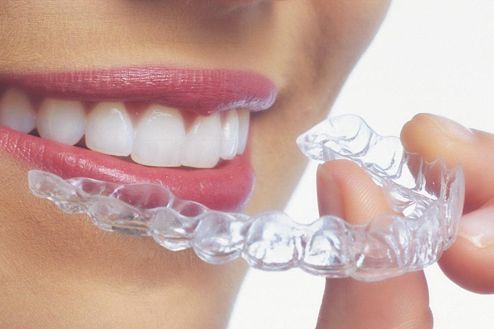 Ortodoncia invisible: Invisalign