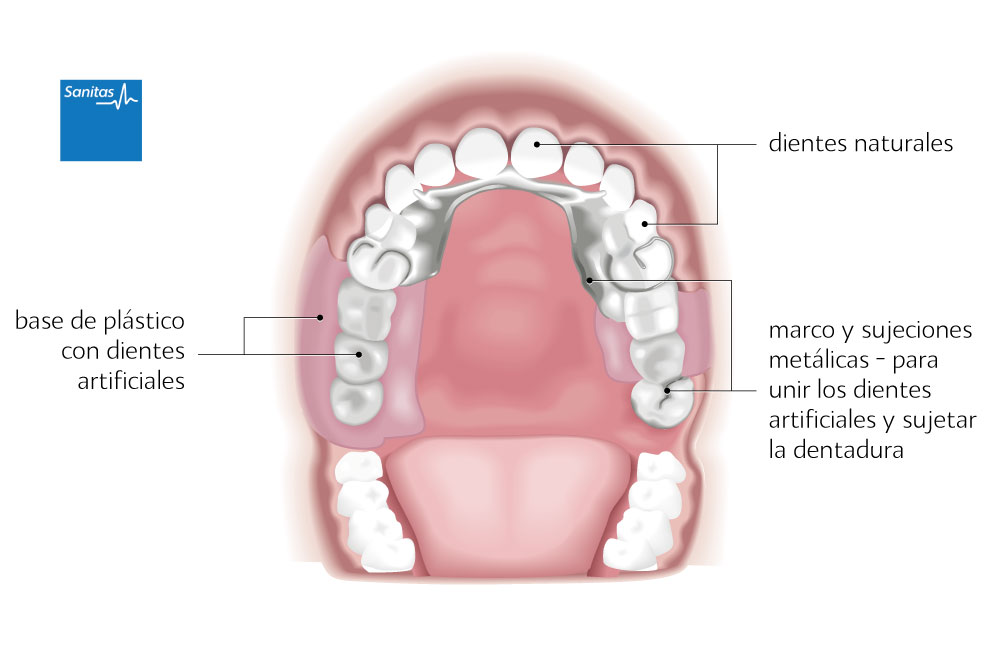 protesis dental removible