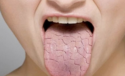 xerostomía síndrome de la boca seca