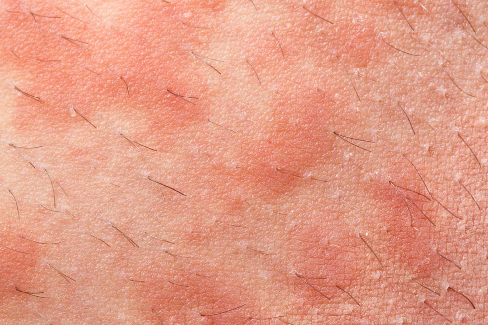 eczemă
