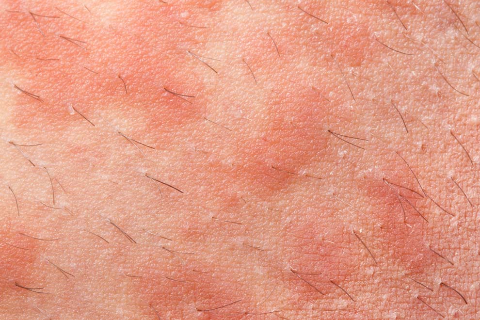 eczema causas