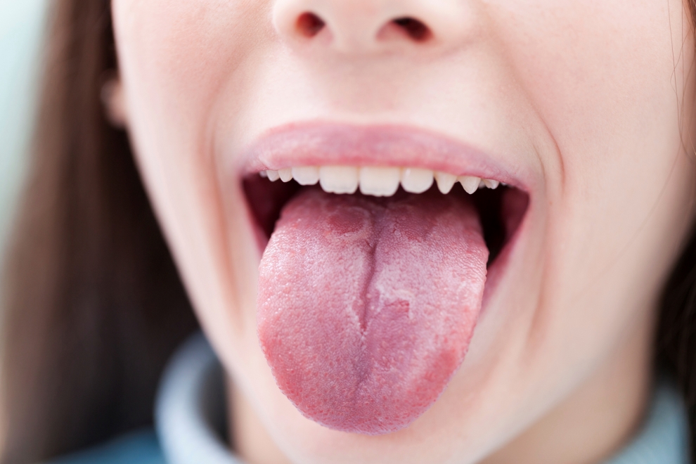 aftas, aftas en la lengua