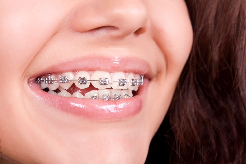 frenillos, frenillos dentales