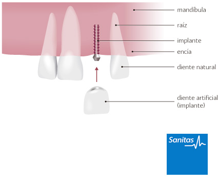 aterrizaje Traer Desesperado Función de un implante osteointegrado