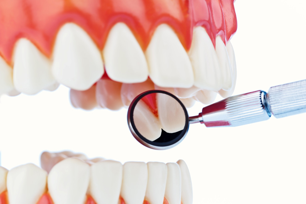 Implantes dentales