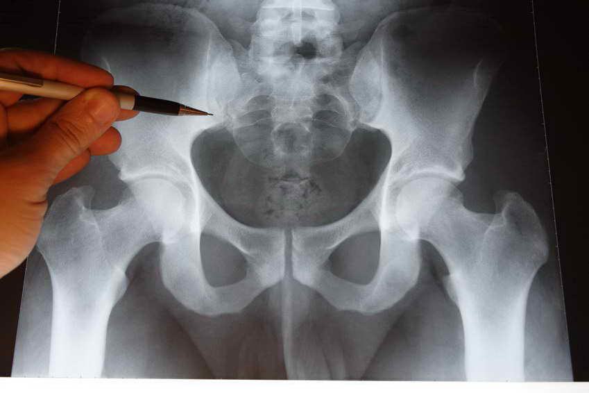 Osteopatía de pubis