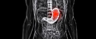 hernia de hiato
