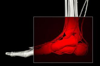 fascitis plantar