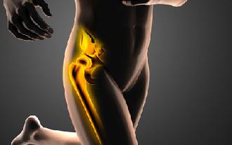 Bursitis de cadera