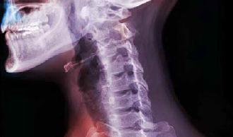 espondilosis vértebra