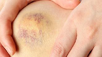 esguince de rodilla