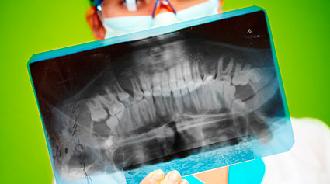 fractura del maxilar