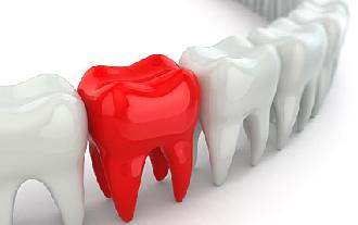 implante dental de zirconio