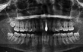 implante dental osteointegrado