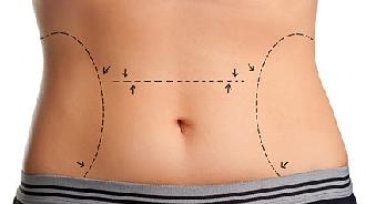 diferencias entre liposucción y lipoescultura