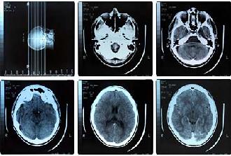 placas neuríticas
