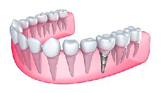 postoperatorio de los implantes dentales