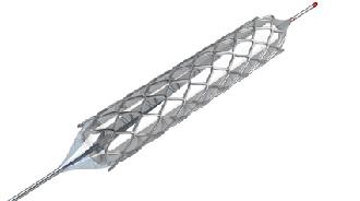 stent circulación sanguínea