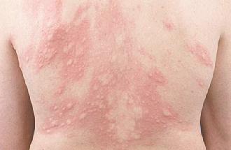 urticaria a frigore