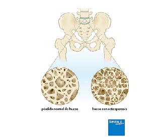 osteoporosis enfermedad huesos