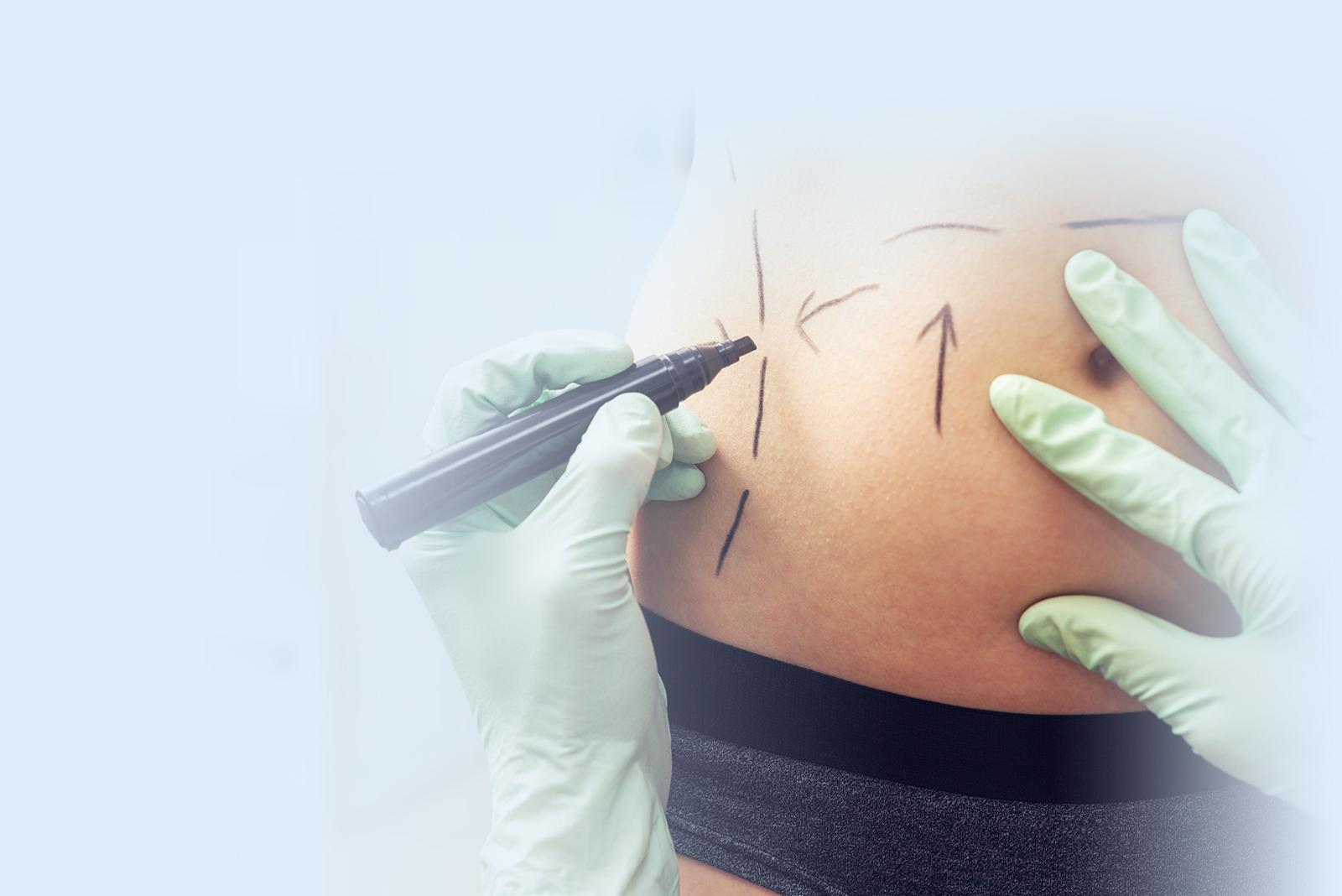 Abdominoplastia Servicios de Salud