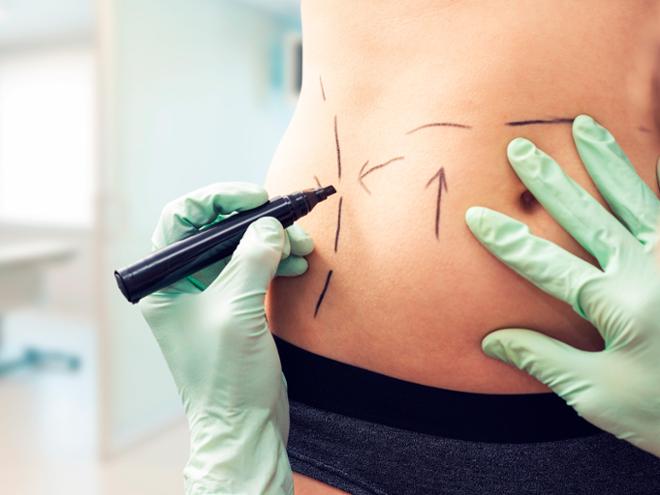 Abdominoplastia Servicios de Salud Sanitas