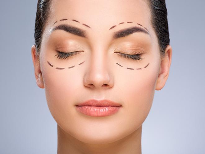 Cirugia de parpados Blefaroplastia