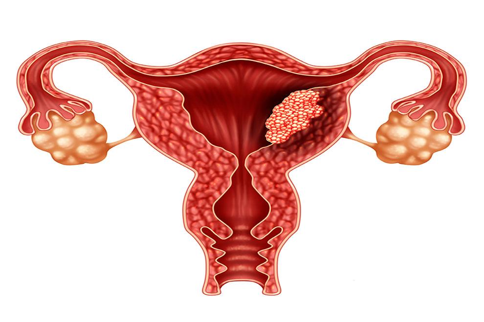 cáncer de útero