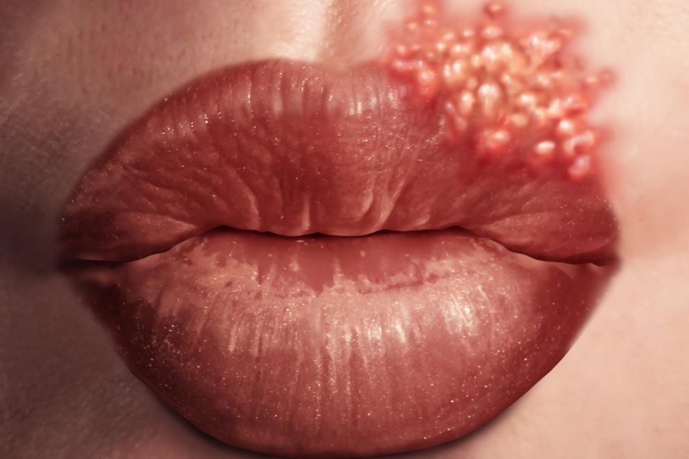 Estomatitis herpética