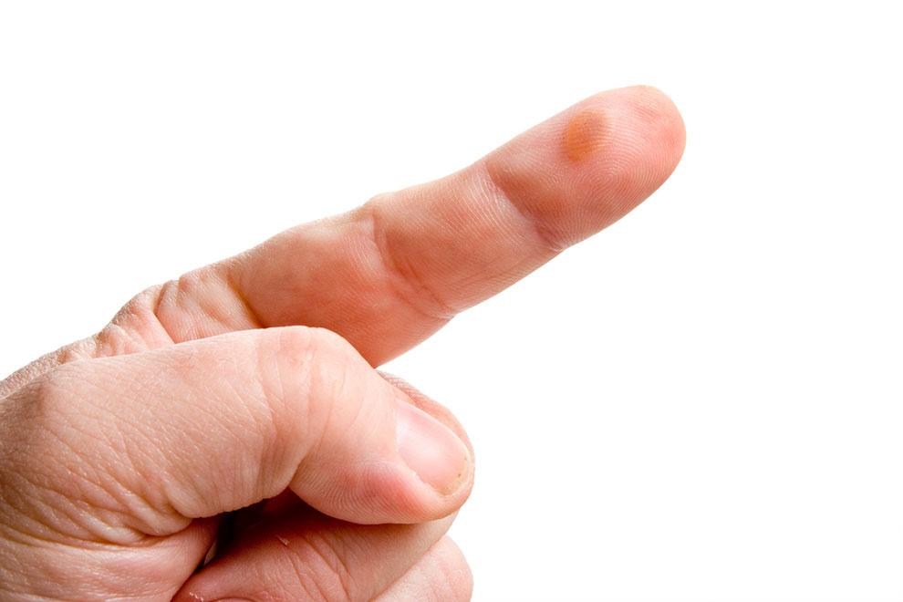 ampollas acumulación líquido