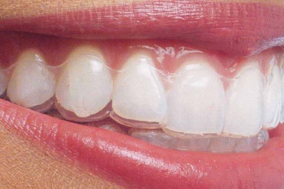 ventajas ortodoncia sin brackets